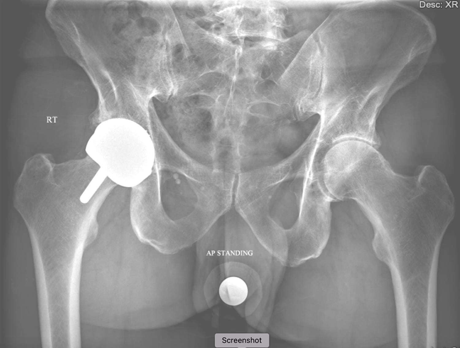 Total Hip Replacement in Atlanta, GA